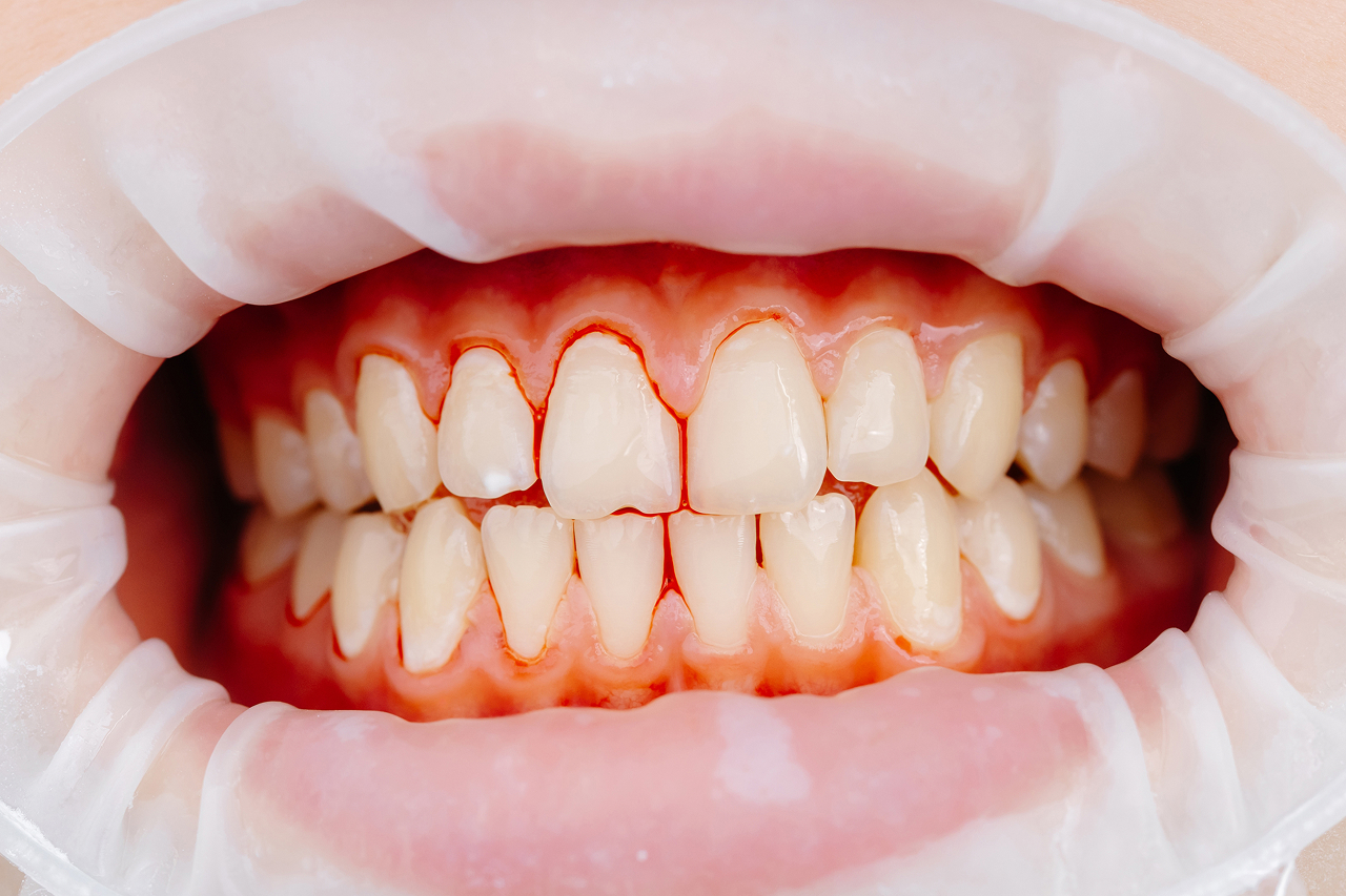 close-up-of-teeth-during-dental-procedure