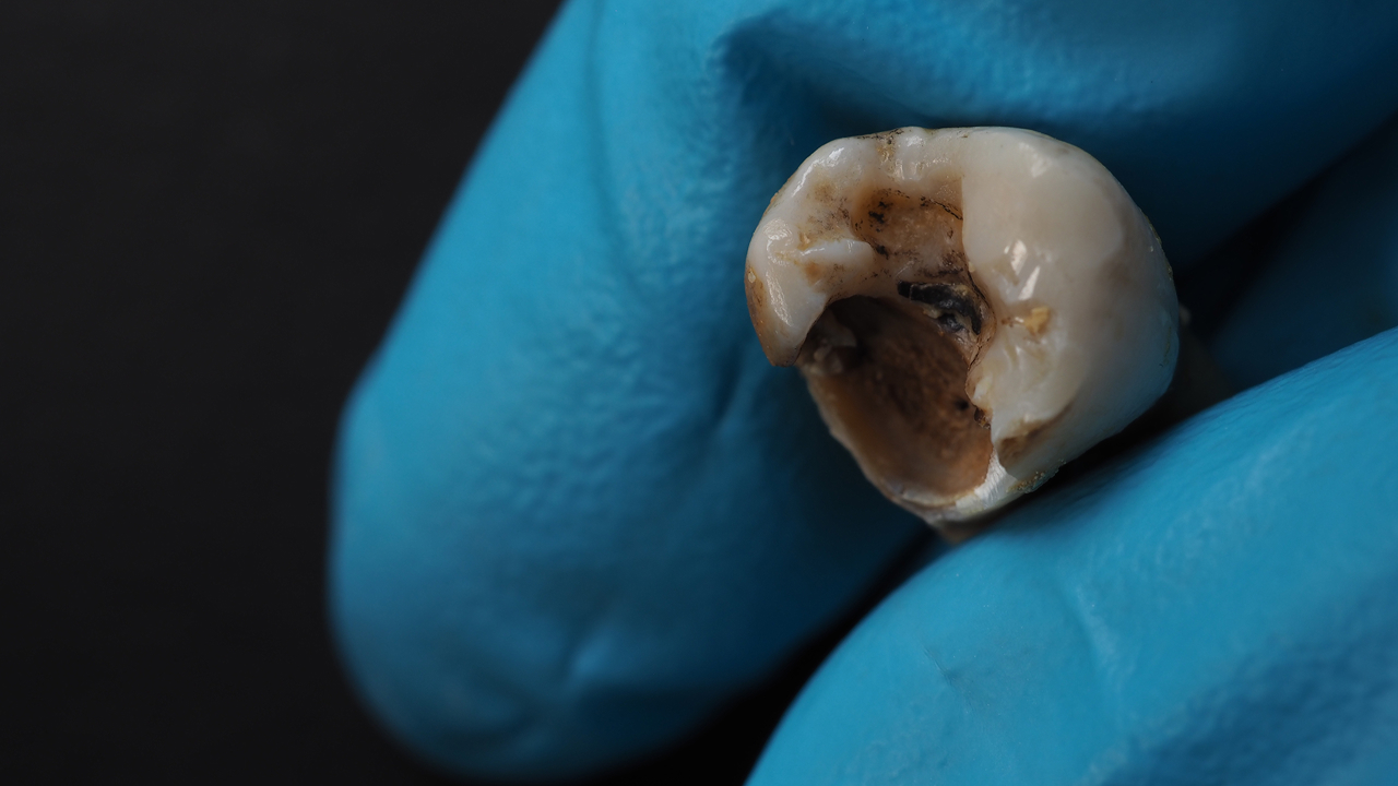 decayed-tooth-held-by-blue-gloved-hand