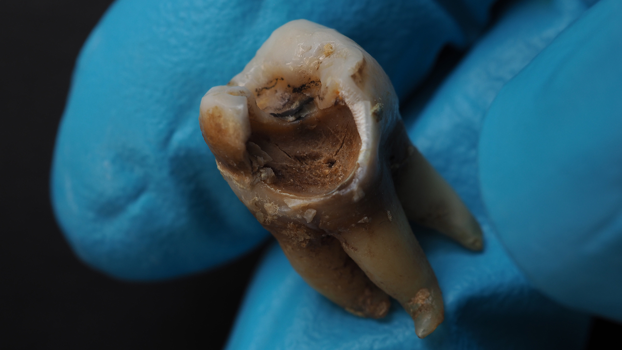 decayed-tooth-in-close-up-medical-setting