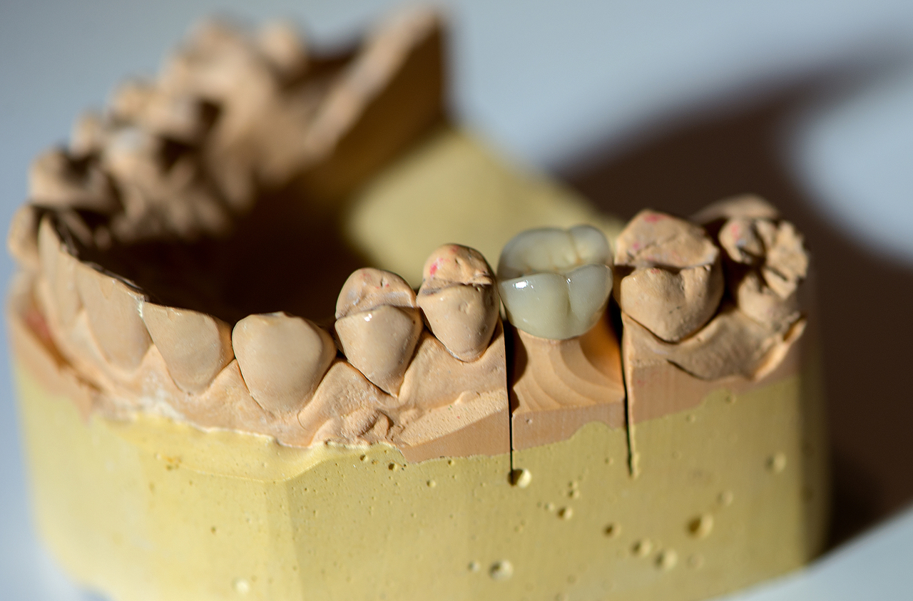 dental-mold-shows-crown-placement-preparation