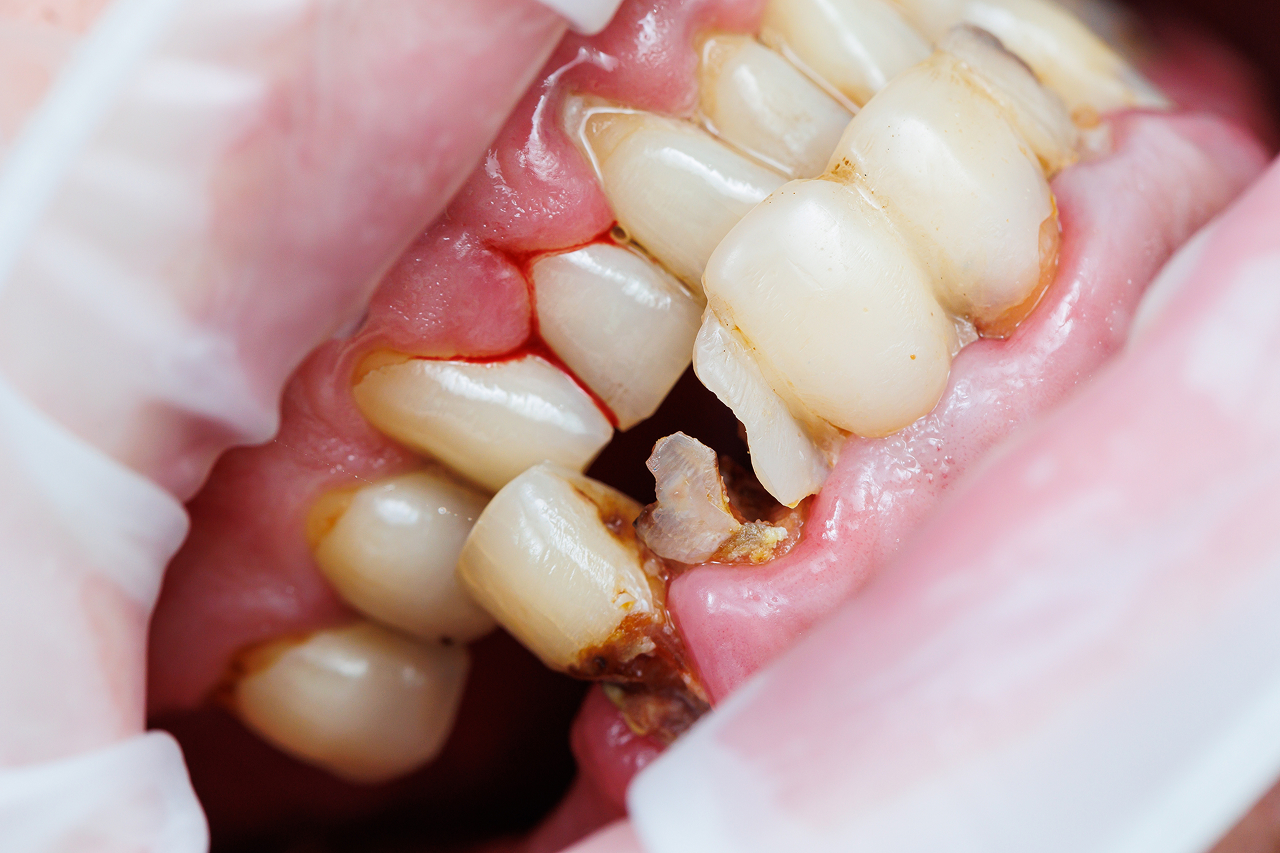 detailed-dental-examination-displays-damaged-tooth