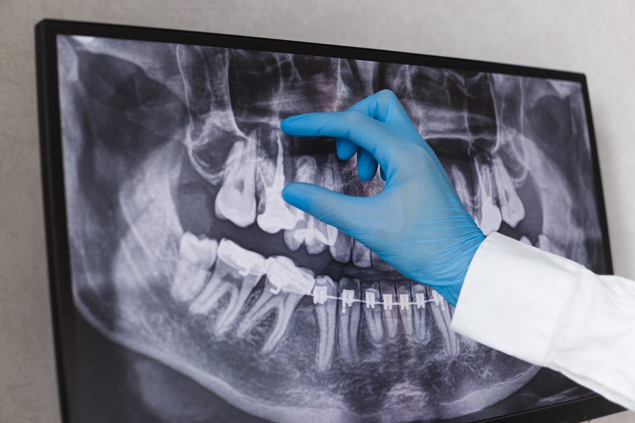doctor-points-to-filled-root-canal-in-dental-x-ray