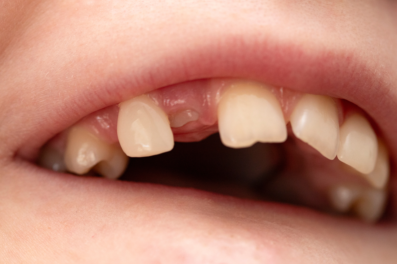 orthodontist-examining-kid-mouth-the-tooth-is