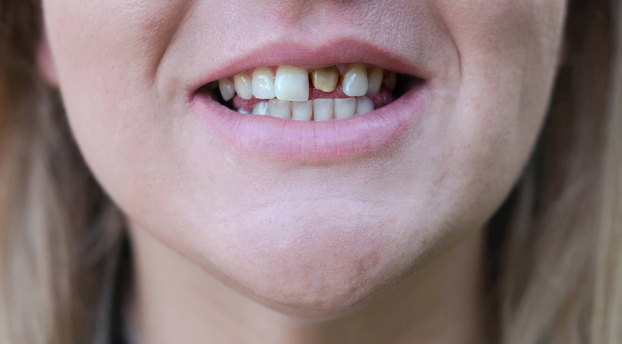 woman-s-smile-with-a-bad-tooth-teeth-before-treat